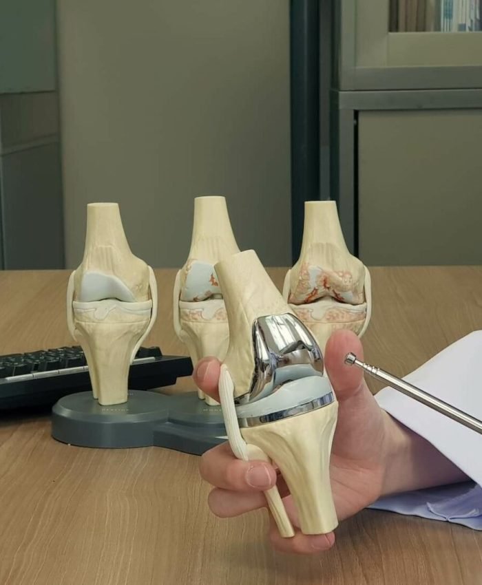 Geleneksel Yöntemlere Karşı Robotik Diz Protezi Hangisi Daha İyi?